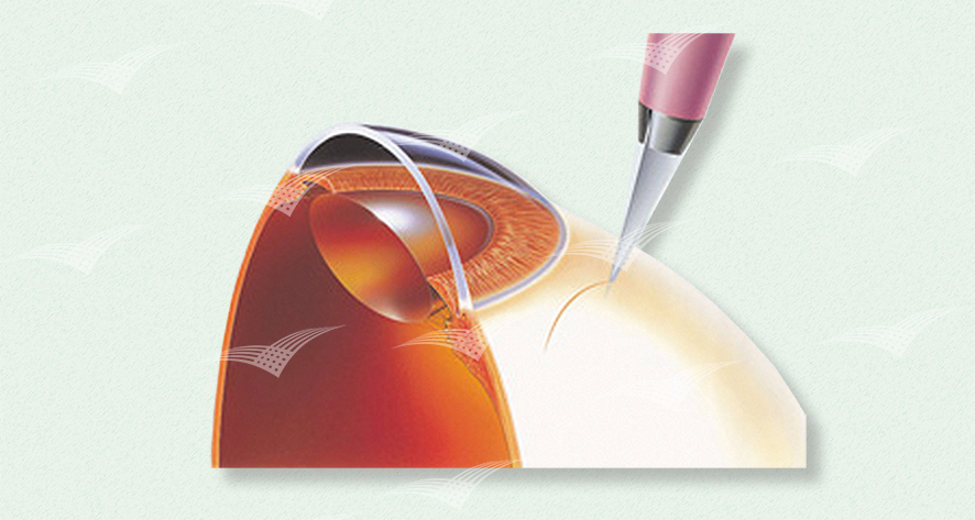 FEATHER_Mikroskalpelle_Stand_Inzision_Anwendung